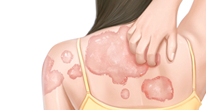 得了体癣赶快调理，因为它真的会传染！！